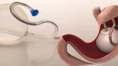 سحب بالون المعدة لمحاربة البدانة من الأسواق بسبب مخاطره الصحية