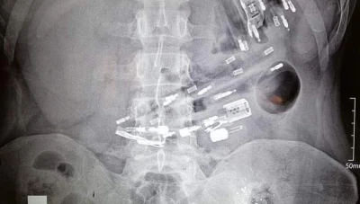 إستخراج مجموعة كبيرة من القداحات من داخل معدة شاب بمدينة الرقة