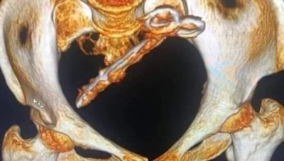 في حادثة صادمة.. اكتشاف مقص جـ. ـراحي "منسي" داخل بطن مريضة منذ 12 سنة