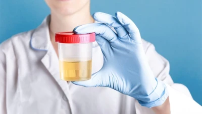 تغير لون البول ممكن أن يكون دليل علي الإصابة بالأمراض؟..إليك التفاصيل