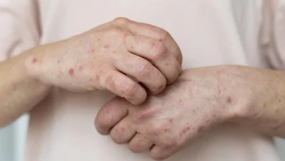 الأمراض الجلدية في الصيف: الأسباب والعوامل وطرق الوقاية