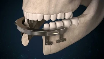 شاب سوري يبتكر جهازاً لبناء مقدمة الفك السفلي والذقن ذاتياً وبحركة دائرية