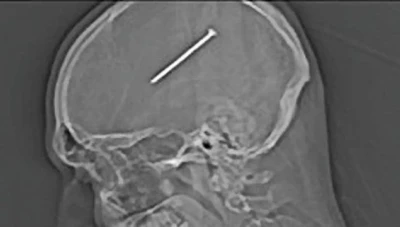 رجل ينجو بأعجوبة من مسمار اخترق عينه واستقر في دماغه!