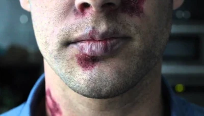 تسجيل حالة “إيـ.ـدز” لأحد الخاطبين