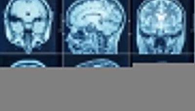 زرع شرائح دماغية في جمـاجم البشر ومخـ.ـاطرها