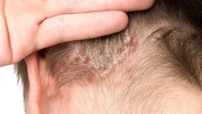 قشرة الرأس: الأسباب والأعراض وطرق العلاج الحديثة