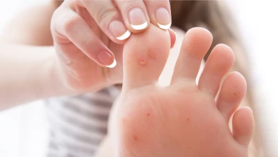 علاج مسمار القدم