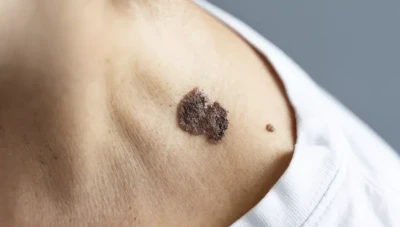 كيفية الوقاية من سرطان الجلد والتعرف على علاماته المبكرة