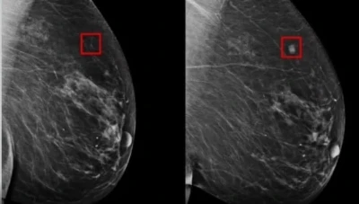 ذكاء اصطناعي جديد يتنبأ بسـ..ـرطان الثدي قبل خمس سنوات