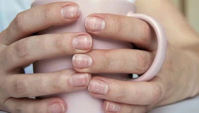 العلامات البيضاء على الأظافر: علامات صحية أم مشكلة صحية؟