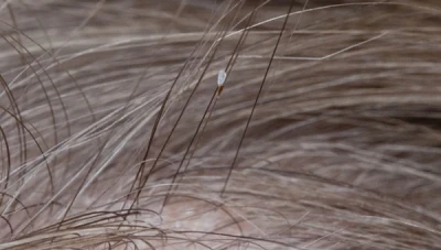 سبل فعّالة للتخلص من القمل: طرق طبيعية ومنزلية للقضاء على الكائن الصغير