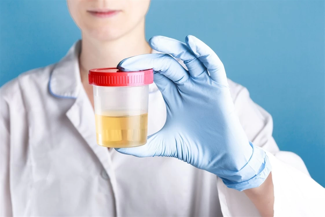 تغير لون البول ممكن أن يكون دليل علي الإصابة بالأمراض؟..إليك التفاصيل