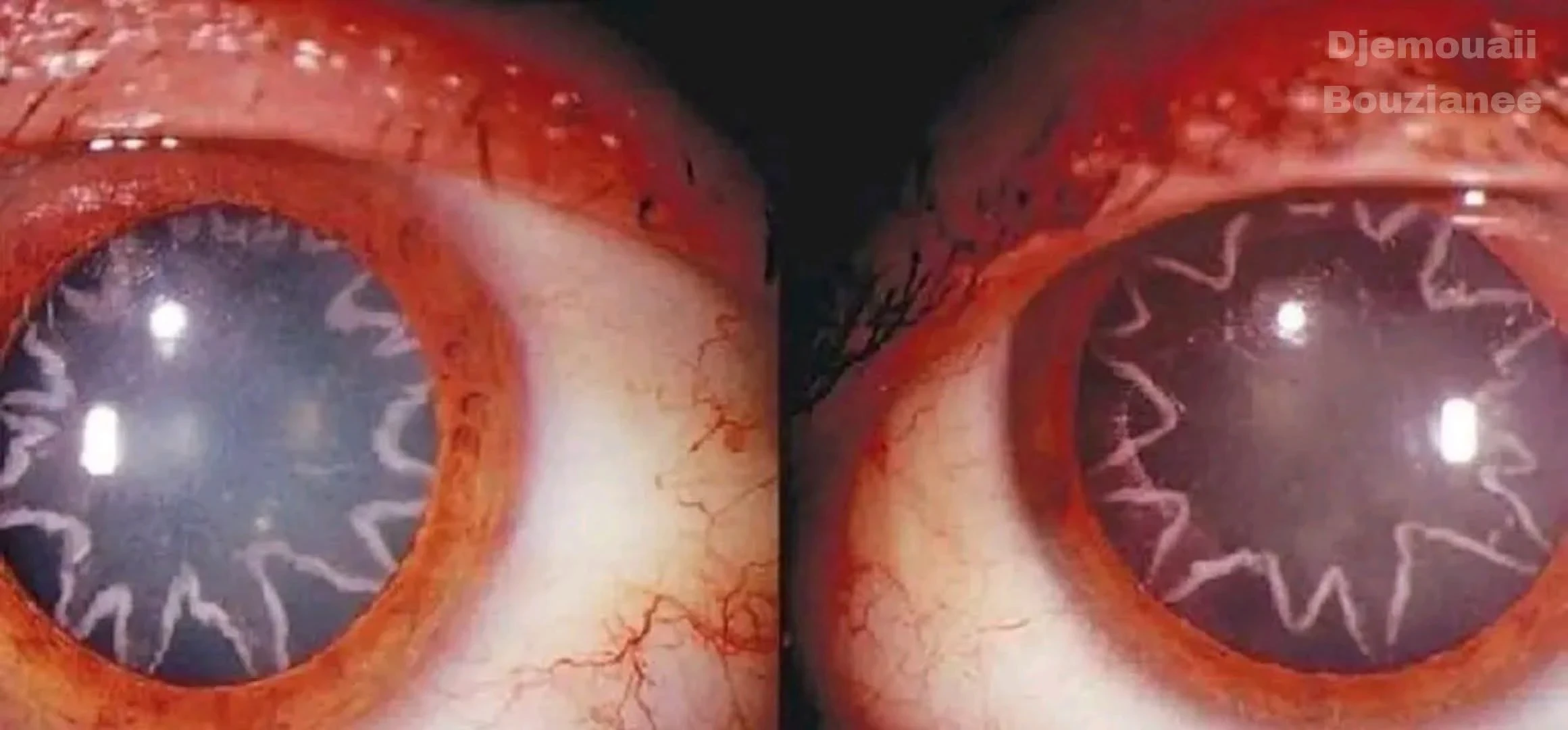 صدمة كهربائية بـ14 ألف فولت تؤدي لظهور نجمتين في عين عامل كهرباء