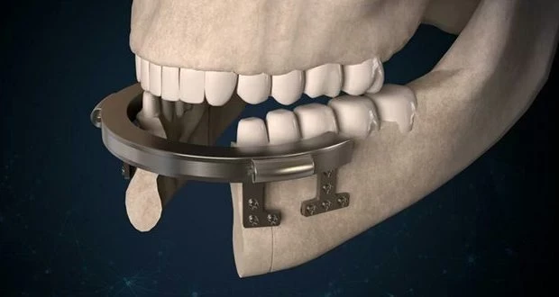 شاب سوري يبتكر جهازاً لبناء مقدمة الفك السفلي والذقن ذاتياً وبحركة دائرية