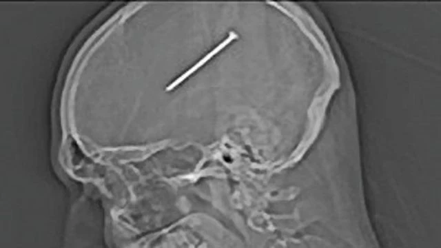 رجل ينجو بأعجوبة من مسمار اخترق عينه واستقر في دماغه!