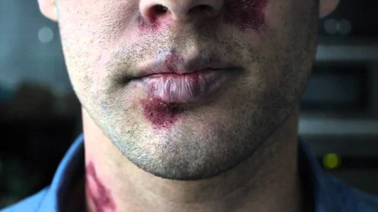 تسجيل حالة “إيـ.ـدز” لأحد الخاطبين