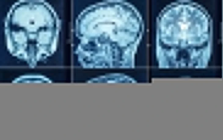 زرع شرائح دماغية في جمـاجم البشر ومخـ.ـاطرها