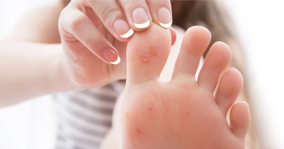 علاج مسمار القدم