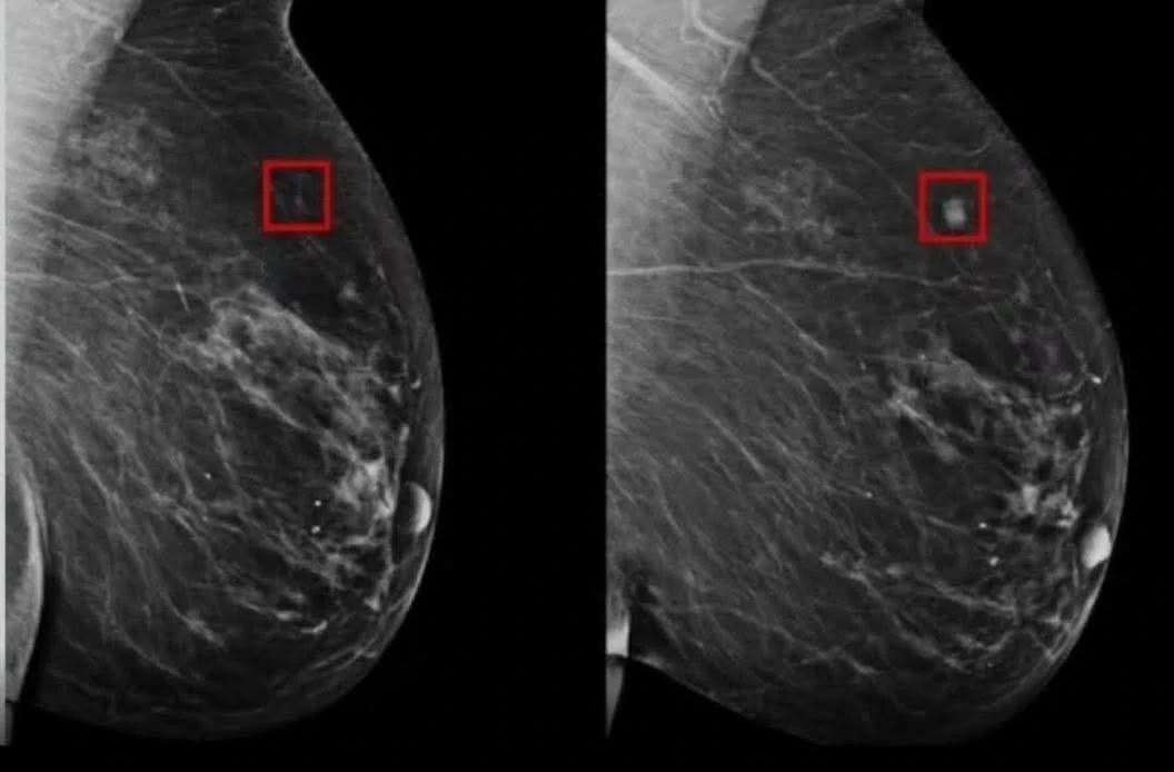 ذكاء اصطناعي جديد يتنبأ بسـ..ـرطان الثدي قبل خمس سنوات